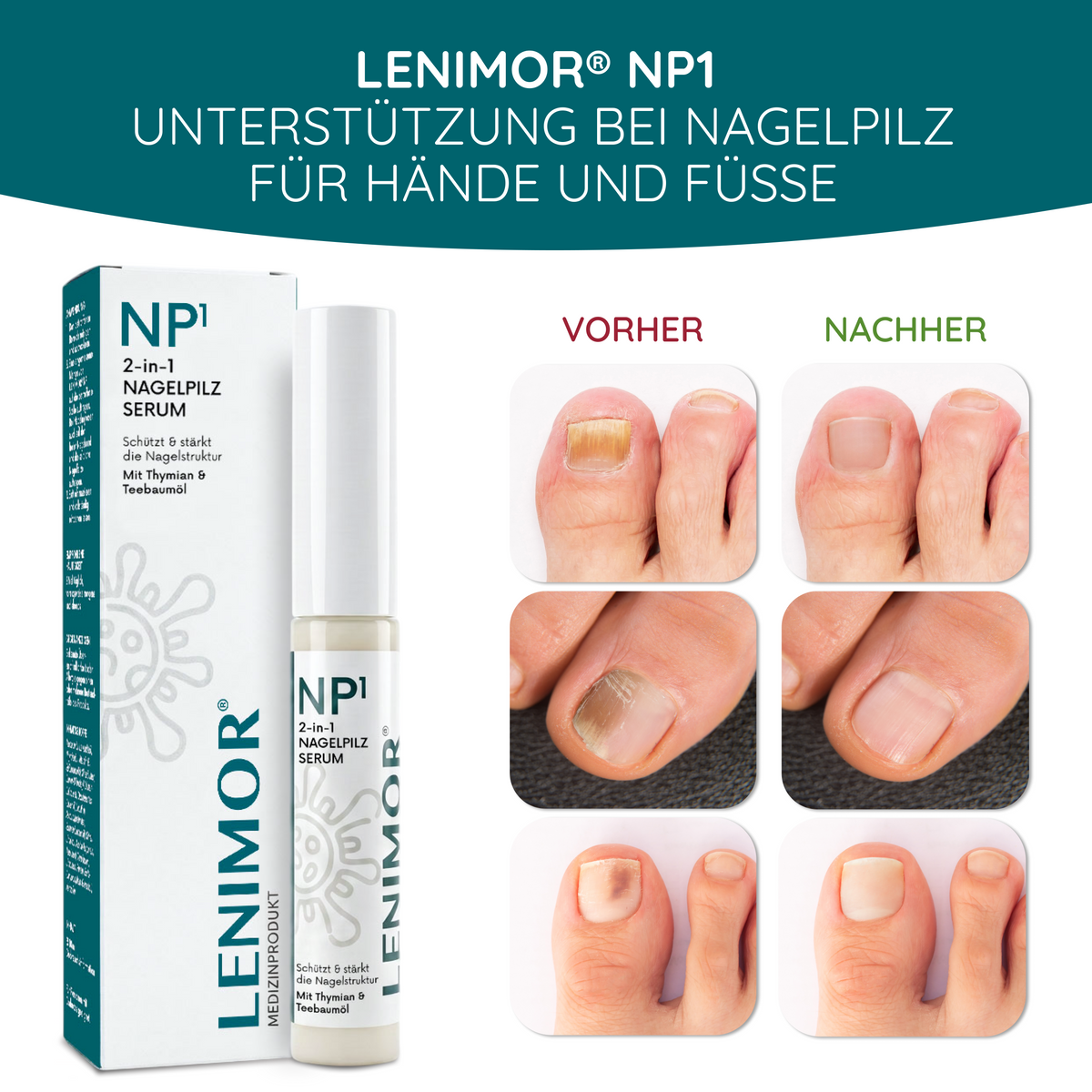 NAGELPILZ Serum - Natürliche Formel mit Teebaumöl & Vitamin E - 10ml