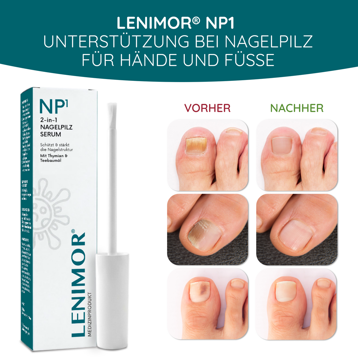 NAGELPILZ Serum - Natürliche Formel mit Teebaumöl & Vitamin E - 10ml