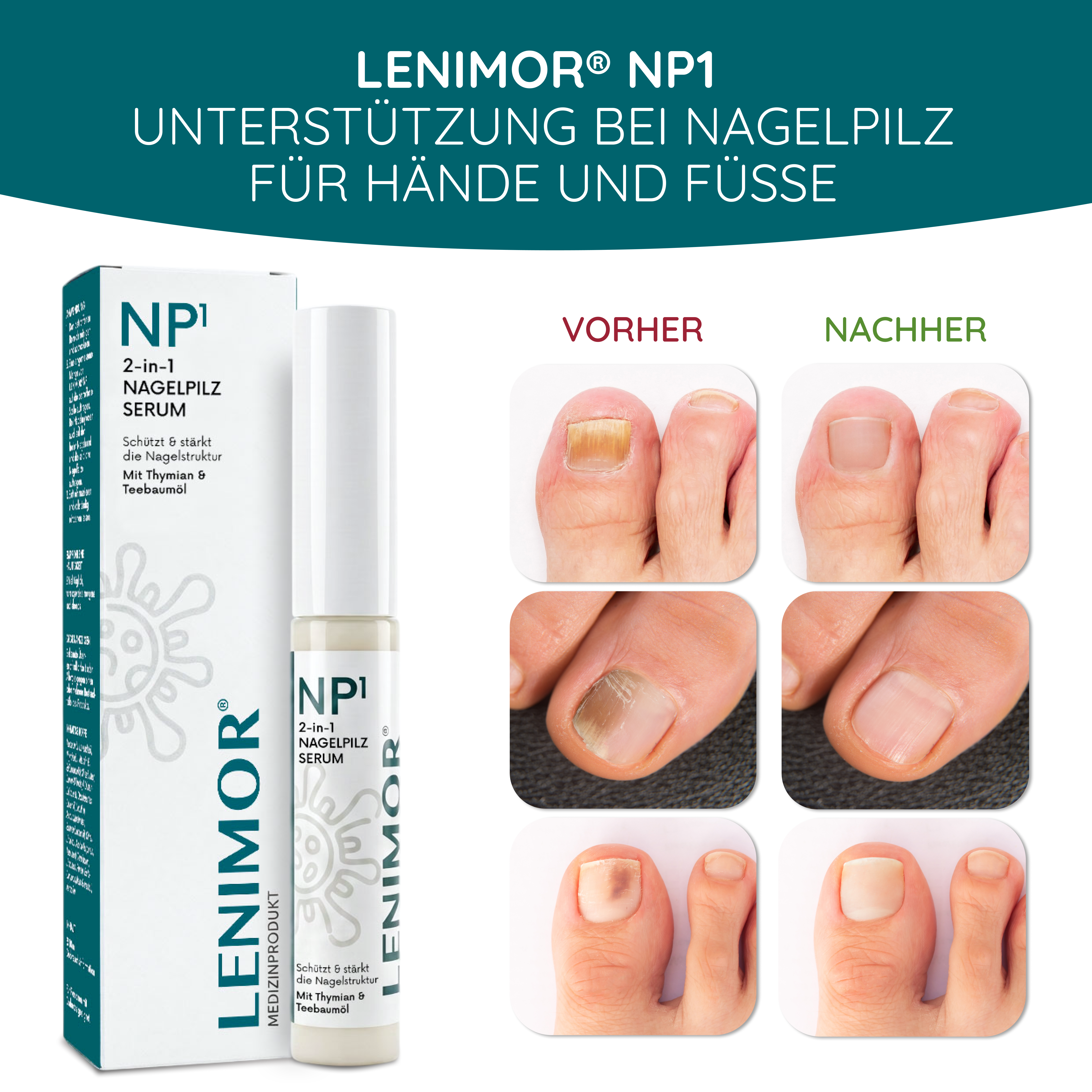 NAGELPILZ Serum - Natürliche Formel mit Teebaumöl & Vitamin E - 10ml